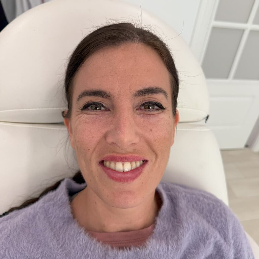 rinoplastia5 1