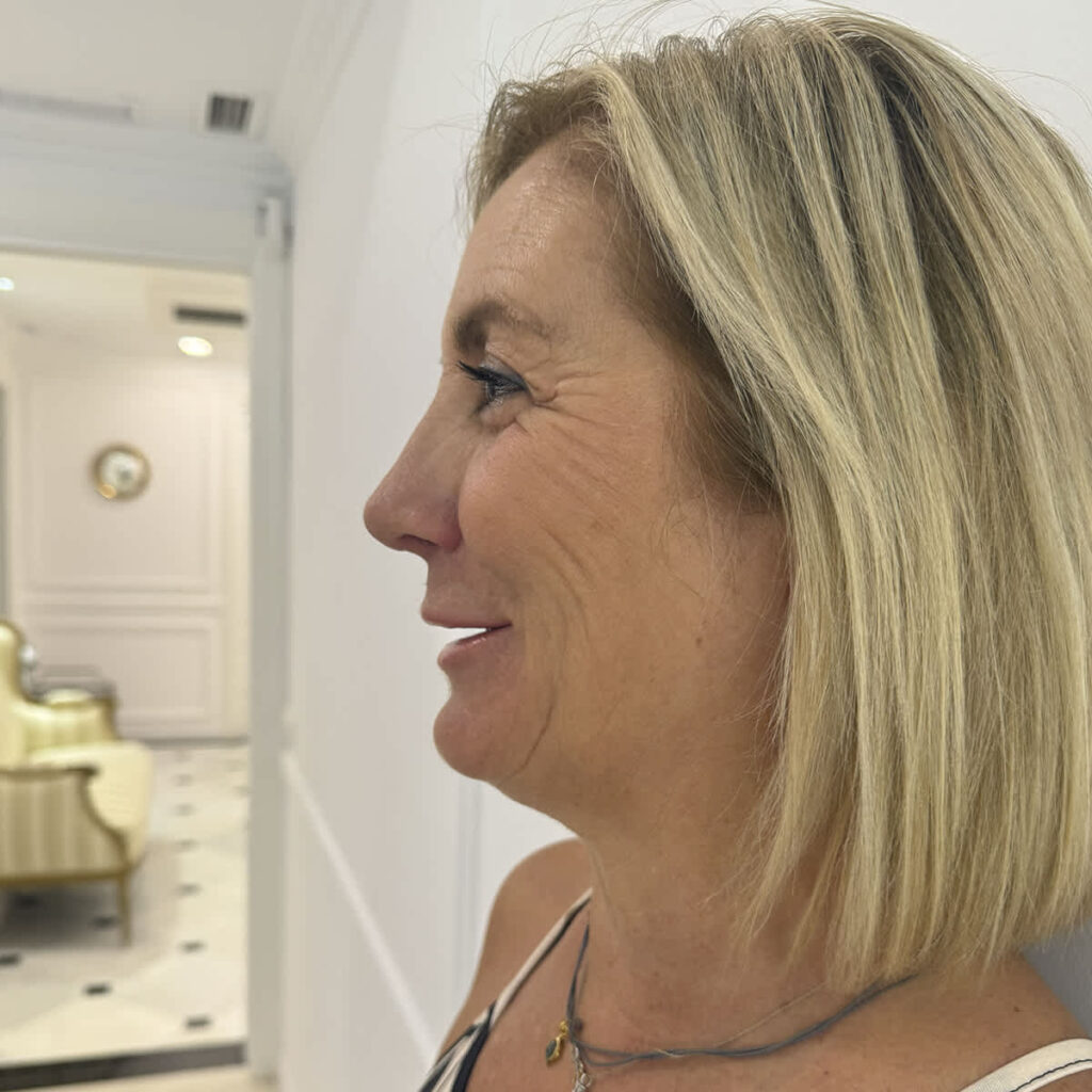 Técnica moderna de rinoplastia de preservación asistida en Barcelona para un resultado natural sin alterar el dorso nasal