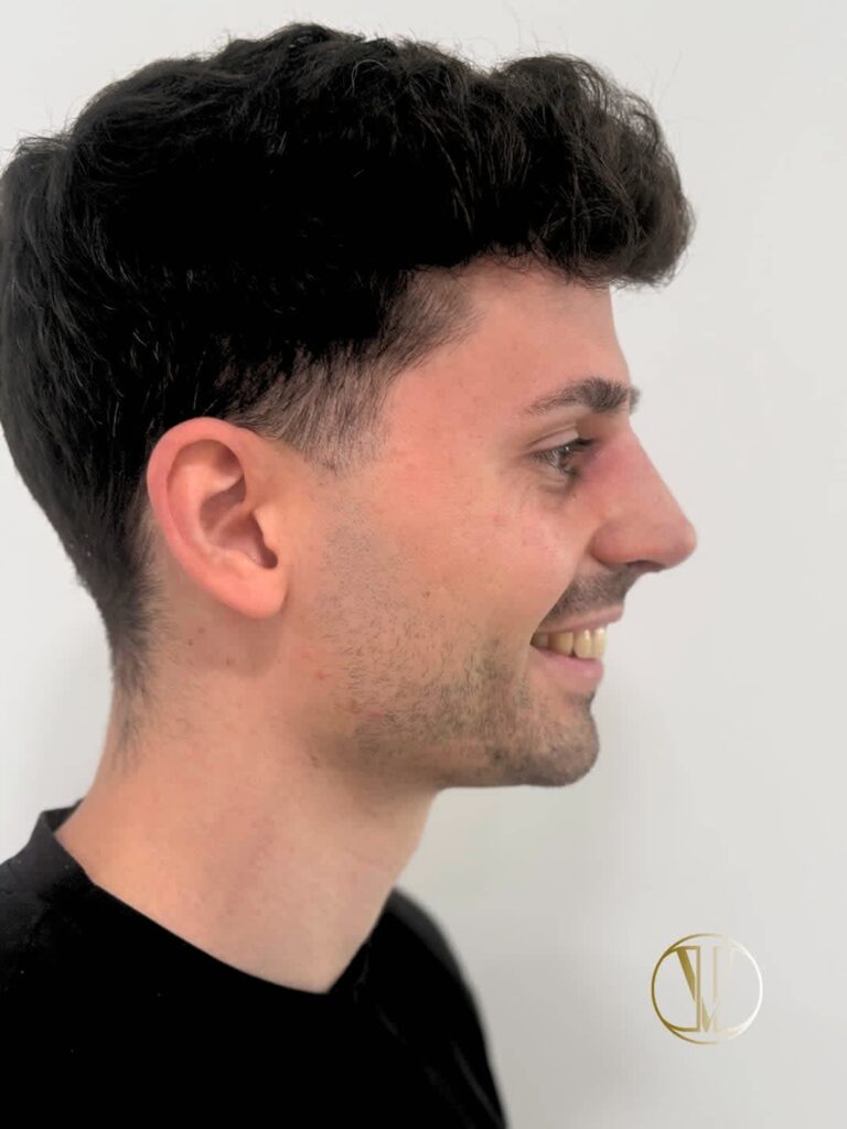 Cirujano especialista realizando una rinoplastia secundaria de revisión o reconstrucción nasal en Barcelona